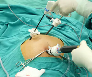 Benefits of Laparoscopic Surgery