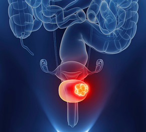 Bladder Cancer