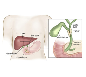 Cholangiocarcinoma Cancer