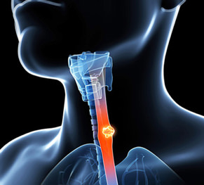 Esophageal Cancer