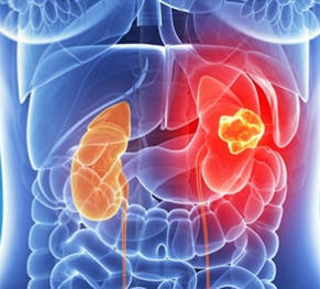 Kidney Cancer