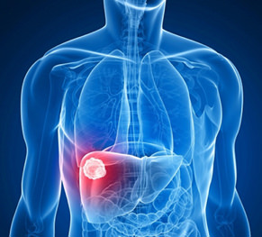 Liver cancer