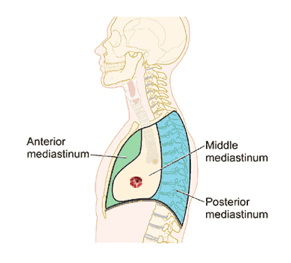 Mediastinal Cancer