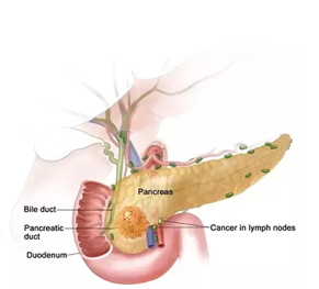 Periampullary Carcinoma